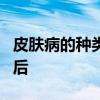 皮肤病的种类 皮肤病有这8个类型，了解清楚后