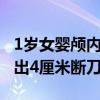 1岁女婴颅内取出4厘米断刀（1岁女婴颅内取出4厘米断刀）