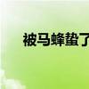 被马蜂蛰了怎么消肿 6个方法快速消肿