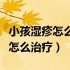 小孩湿疹怎么治疗好得最快最有效（小孩湿疹怎么治疗）