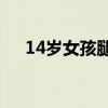 14岁女孩腿上有紫色的血纹是怎么回事