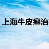 上海牛皮癣治疗医院（上海牛皮癣治疗医院）