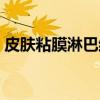 皮肤粘膜淋巴结（关于皮肤粘膜淋巴结介绍）