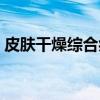 皮肤干燥综合症（关于皮肤干燥综合症介绍）