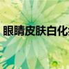 眼睛皮肤白化症(关于眼睛皮肤白化症介绍) 眼睛皮肤白化症(关于眼睛皮肤白化症介绍)