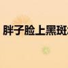 胖子脸上黑斑怎么回事（脸上有黑斑吃什么）