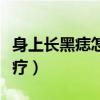 身上长黑痣怎样防止恶变（身上长黑痣怎么治疗）