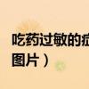 吃药过敏的症状是怎样的（吃药过敏的症状的图片）