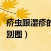 疥虫跟湿疹的区别图片大全（疥虫跟湿疹的区别图）