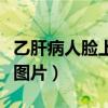 乙肝病人脸上有斑的图片（乙肝患者脸上肝斑图片）