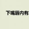 下嘴唇内有水泡(下嘴唇里面起水泡图) 下嘴唇内有水泡(下嘴唇里面起水泡图)