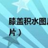 膝盖积水图片 治疗方法（膝盖积水的症状图片）