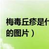 梅毒丘疹是什么样子的图片（丘疹是什么样子的图片）