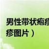 男性带状疱疹图片初期症状图片（男性带状疱疹图片）