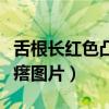 舌根长红色凸起大颗粒图片（舌根长红色肉疙瘩图片）