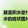 膝盖积水是什么原因造成的怎么治疗(膝盖积水的症状图片) 膝盖积水是什么原因造成的怎么治疗(膝盖积水的症状图片)