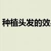 种植头发的效果能保持多久（头发种植效果）
