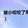 被小咬咬了用什么药（被小咬咬了涂什么药好）