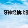 牙神经抽出图片（牙神经抽出来的过程图）