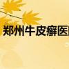 郑州牛皮癣医院哪个较好（郑州牛皮癣医院）