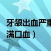 牙龈出血严重满口血怎么止血（牙龈出血严重满口血）