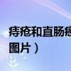 痔疮和直肠癌的出血区别（痔疮和直肠癌便血图片）