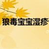 狼毒宝宝湿疹膏副作用吗（狼毒宝宝湿疹膏）