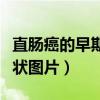 直肠癌的早期症状图片男性（直肠癌的早期症状图片）