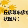 丘疹荨麻疹症状图片用什么药（丘疹荨麻疹症状图片）