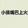 小孩嘴巴上火起泡图片（小孩嘴唇起泡图片）
