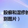 股癣和湿疹的区别图片对比（股癣和湿疹的区别图片）