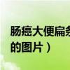 肠癌大便扁条状图片 (第1页)（肠癌大便凹槽的图片）
