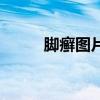 脚癣图片和症状图片（脚癣图片）
