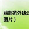 脸部紫外线过敏怎么解决（脸紫外线过敏症状图片）