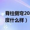 脊柱侧弯20度是什么样子的（脊柱侧弯20多度什么样）