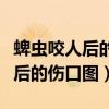 蜱虫咬人后的伤口图会有一个圈吗（蜱虫咬人后的伤口图）