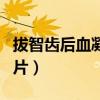 拔智齿后血凝块图片大全（拔智齿后血凝块图片）