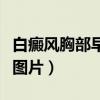 白癜风胸部早期症状图片（白癜风最早期症状图片）