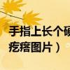 手指上长个硬疙瘩肿疼咋回事（手指上起个硬疙瘩图片）