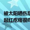 被太阳晒伤后皮肤又痒又痛怎么办（被太阳晒起红疙瘩很痒）