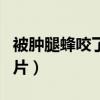 被肿腿蜂咬了抹什么药（肿腿蜂咬人后症状图片）