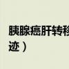 胰腺癌肝转移中医调理（胰腺癌肝转移中药奇迹）