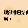 颈部淋巴结良性的表现（老用手摸淋巴结的后果）