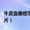 牛皮血癣症怎么治疗除根（脚上起癣有几种图片）