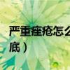 严重痤疮怎么治疗最彻底（痤疮怎么治疗最彻底）