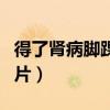 得了肾病脚踝肿是什么样（得了肾病脚踝肿图片）