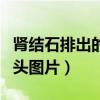 肾结石排出的石头图片真实（肾结石排出的石头图片）