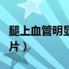 腿上血管明显怎么回事（腿上血管很明显的图片）