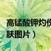 高锰酸钾灼伤皮肤图片大全（高锰酸钾灼伤皮肤图片）