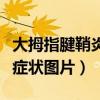 大拇指腱鞘炎有什么症状图片（大拇指腱鞘炎症状图片）